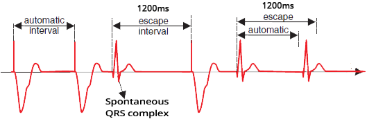 ECG pacemaker, hysteresis, automatic interval, escape interval, paced QRS, spontaneous QRS complex