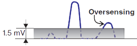 Pacemaker oversensing