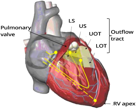 Right ventricular pacing, RV apical pacing, RV outflow tract pacing