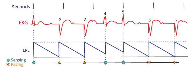 Pacemaker VVI mode pacing, paced QRS complexes, ventricular extrasystole, normal QRS, Lower rate limit