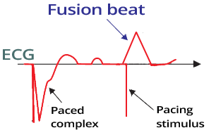 ECG pacemaker fusion beat