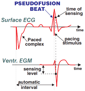 ECG pacemaker pseudofusion beat