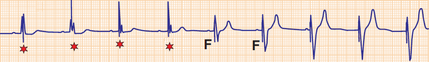 Pacemaker VVI mode, fusion beats, pseudofusion beats