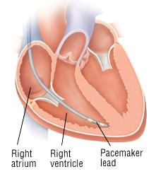 Single chamber pacemaker, VVI mode