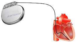 Unipolar Pacemaker VVI mode