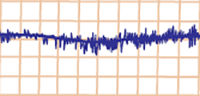 ECG myopotential interference