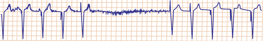 Unipolar paacemaker VVI mode inhibition, myopotential oversensing, myopotential interference