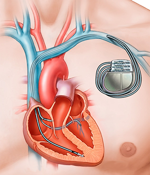 Pacemaker myopotential interference