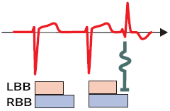 ECG aberrant conduction premature atrial complex, RBBB morphology, refractory period