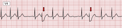 ECG ashman phenomenon, RBBB, aberrant conduction