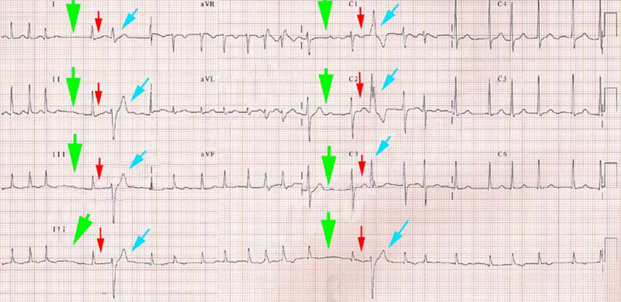 ECG Gouaux-Ashman phenomenon, aberrant conduction, relative refractory period and RBBB morphology