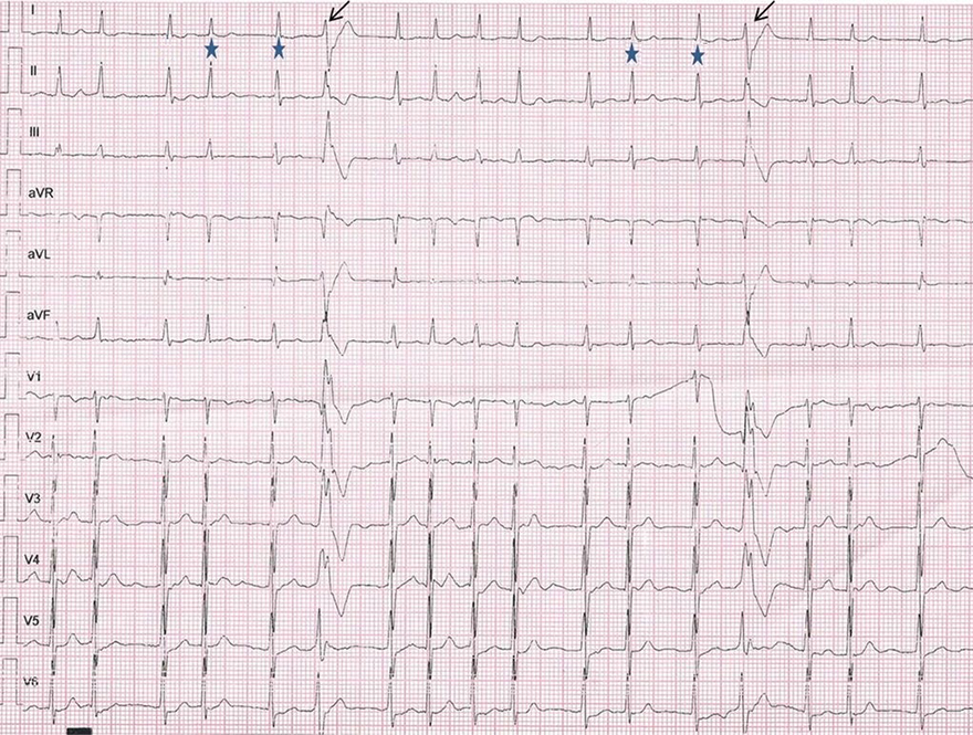 ECG ashman phenomenon, RBBB aberracy, long-short RR interval