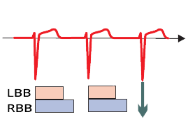 ECG normal supraventricular impulse conduction via phase 3 action potential, relative refractory period