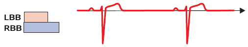 ECG normal sinus rhythm with normal conduction