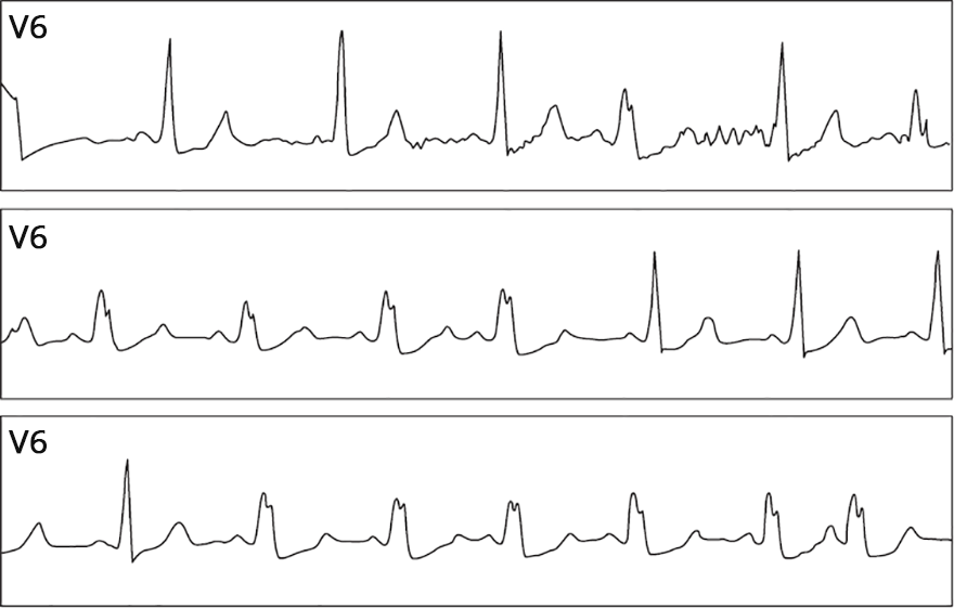 ECG LBBB appears with heart rate 70bpm, refractoriness LBB, Phase 3 Aberrancy, Tachycardia-dependent aberration