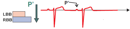 ECG premature atrial complex, normal intraventricular conduction