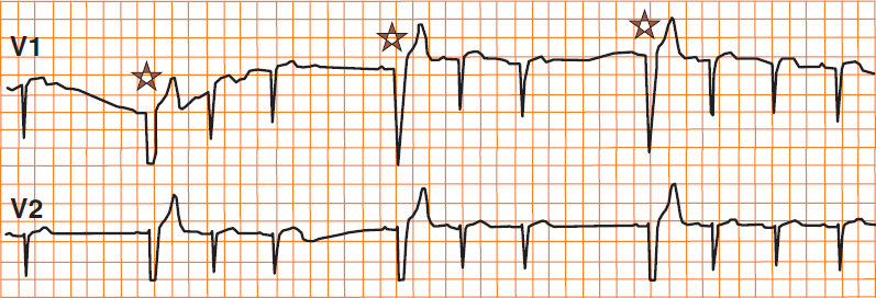 ECG  phase 4 block (LBBB), Bradycardia-dependent aberration, Bradycardia-dependent BBB