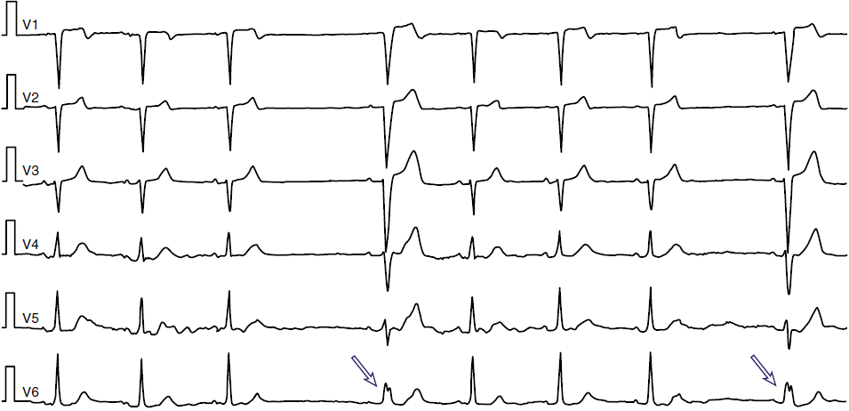 ECG LBBB pattern, Phase 4 block, Bradycardia-dependent aberration, Bradycardia-dependent BBB