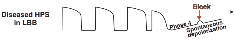 Action potential - Abnormal His-Purkinje cells, Bradycardia-dependent aberration, Bradycardia-dependent BBB (phase 4 block)