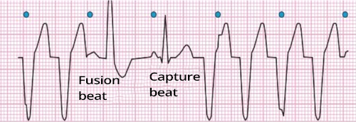 ECG ventricular tachycardia (broad QRS), fusion beat, capture beat