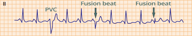 ECG ventricular fusion beat, premature ventricular complex, sinus rhythm