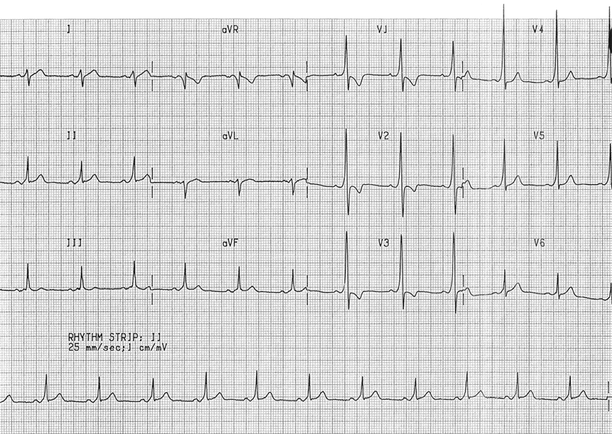 ECG WPW syndrome Type A, fusion beat - delta wave