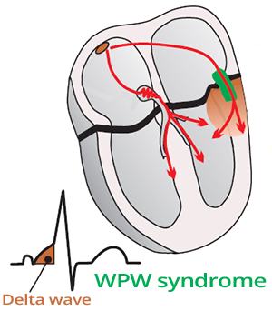 ECG fusion beat, WPW syndrome, delta wave, accessory pathway bundle of Kent