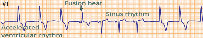 ECG ventricular fusion beat, accelerated idioventricular rhythm, sinus rhythm