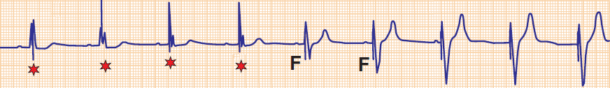 ECG VVI pacemaker, fusion beat, pseudo-fusion beat