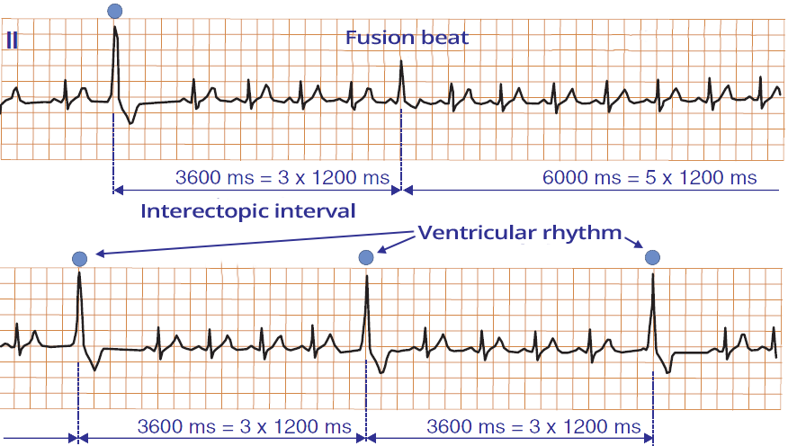 ECG parasystole, ventricular fusio beat, varying coupling interval, interectopic interval