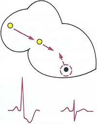 ECG, electrical vectors, ventricular fusion beat