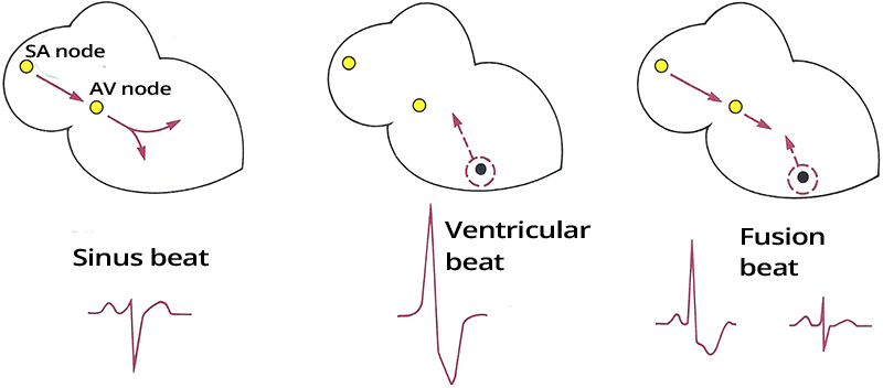 Sinus beat (narrow QRS), Ventricular beat (broad QRS), Ventricular fusion