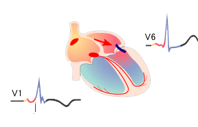 WPW syndrome left accessory pathway