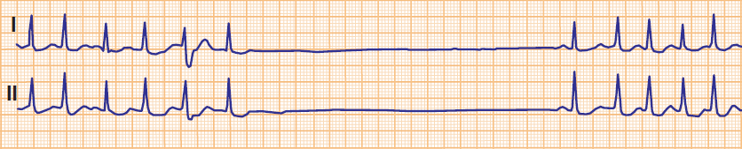 ECG SSS, atrial fibrillation, asystole, absence of AV junctional escape rhythm, Sinus node recovery time