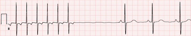 ECG overdrive suppression, lower nonsinus pacemaker - AVNRT, SA node, primary and secondary pacemaker