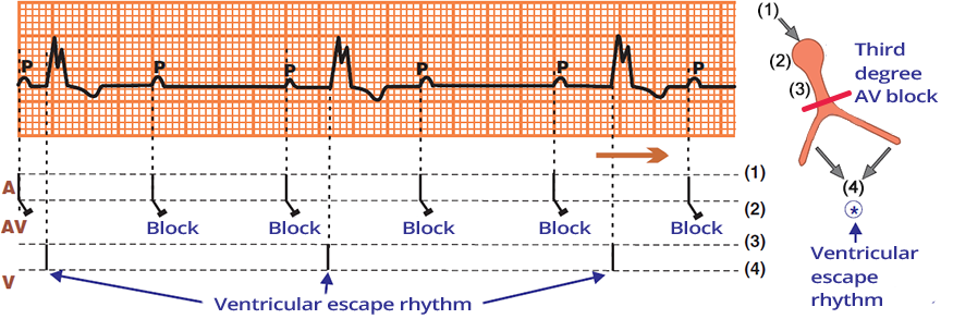 Laddergram (ECG) Complete 3rd degree AV block, atrioventricular (AV) dissociation