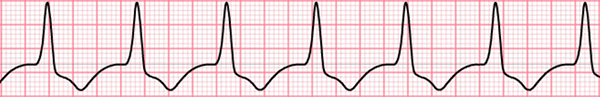 ECG ventricular rhythm, broad QRS, regular rhythm