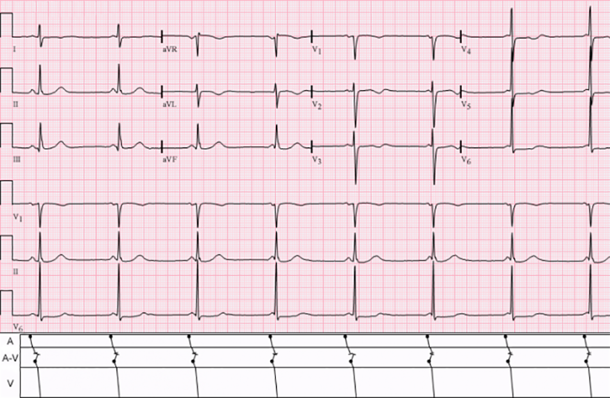 ECG isorhytmic AV dissociation, sinus rhythm, accelerated AV junctional rhythm