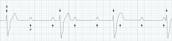 ECG 3rd degree complete AV block, First sinus rhythm (P waves), second ventricular rhythm (broad QRS)