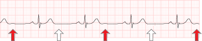 ECG Electrical U wave alternans