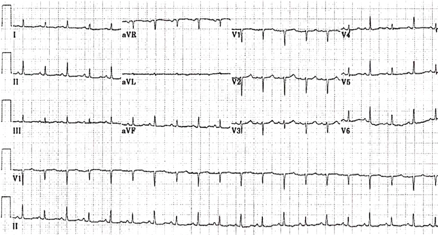 ECG peridardial effusion triad: Sinus tachycardia, QRS alternans, Low QRS amplitude