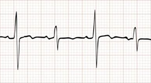 ECG QRS alternans, massive pericardial effusion, mechanical swinging