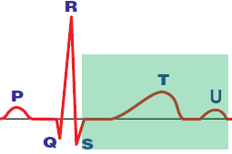 ECG repolarization alternans, T wave alternans, U wave alternans, ST segment alternans