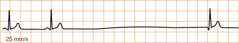ECG sick sinus syndrome (SSS), abrupt sinus arrest junctional escape beat