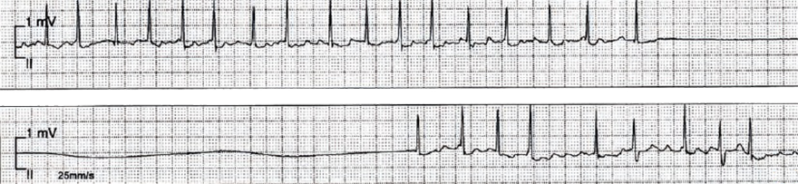 Sick sinus syndrome (SSS), sinus dysfunction, sinoatrial node disease (SND), Tachycardia-bradycardia syndrome, paroxyzmal atrial fibrillation, 7second sinus pause, overdrive suppression, ventricular asystole