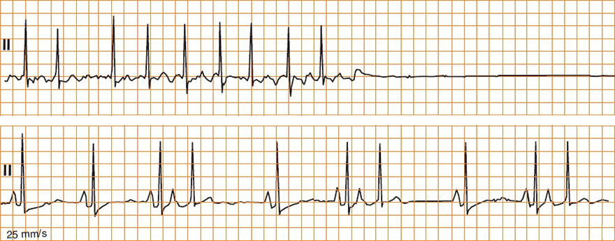 ECG sick sinus syndorme (SSS), atrial fibrillation, prolonged sinus arrest, atrial premature complex - beat