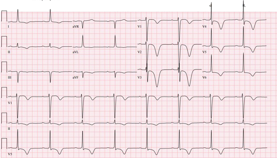 ECG cardiac memory T waves, after WPW syndrome accessory pathway ablation