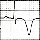 ECG Chatterjee phenomenon (Post pacing T wave inversion)