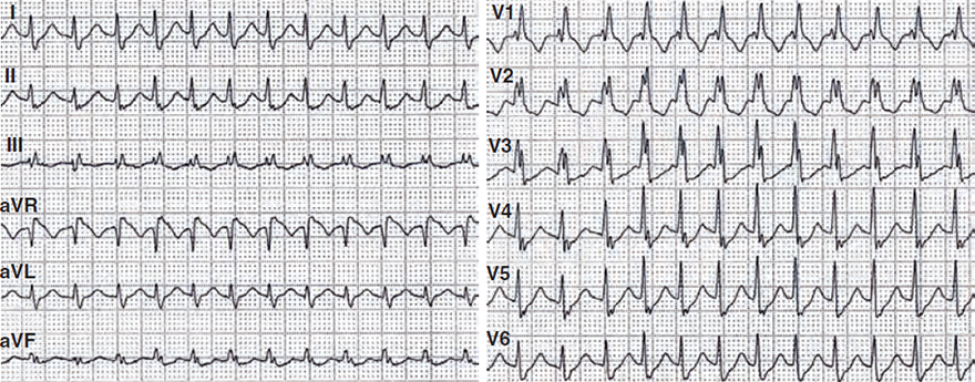 ECG aberrant AVNRT with RBBB, aberrant wide complex supraventricular (SVT) tachycardia