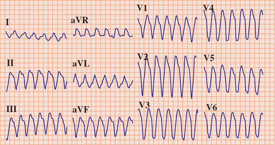 ECG wide QRS complex tachycardia, ventricular tachycardia